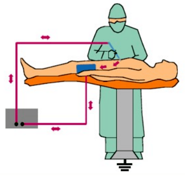 高頻手術(shù)示意圖 高頻手術(shù)示意圖