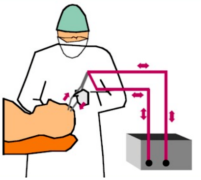 雙相性心衰手術(shù)示意圖 雙相性心衰手術(shù)示意圖